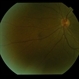 Normal Eye Normal Eye